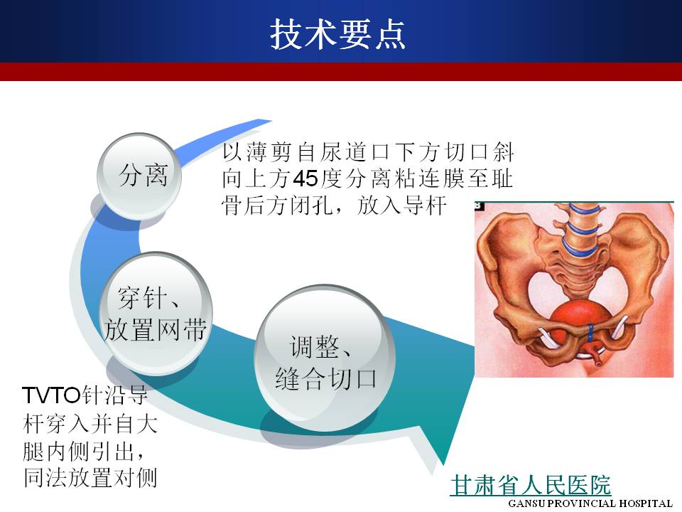 经闭孔尿道悬吊术图解图片